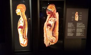 肥満の人（１３６ｋｇ）の断面図（右）